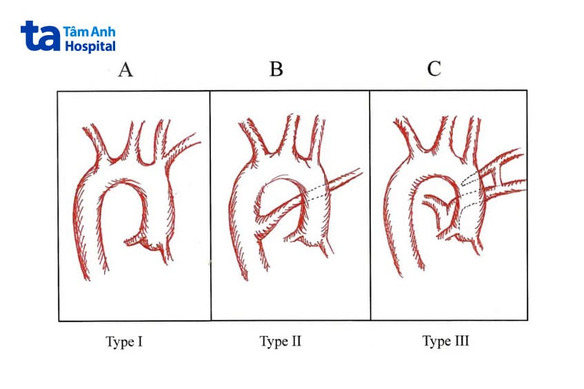 các trường hợp cung động mạch chủ quay phải