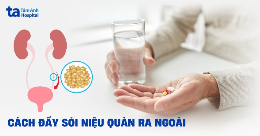 5 cách đẩy sỏi niệu quản ra ngoài hiệu quả, an toàn tại nhà