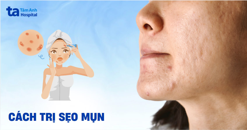7 cách trị sẹo mụn trên mặt lâu năm chuẩn y khoa Da liễu