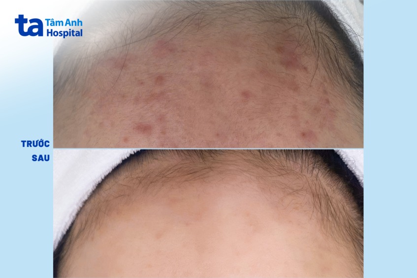 cải thiện sẹo mụn