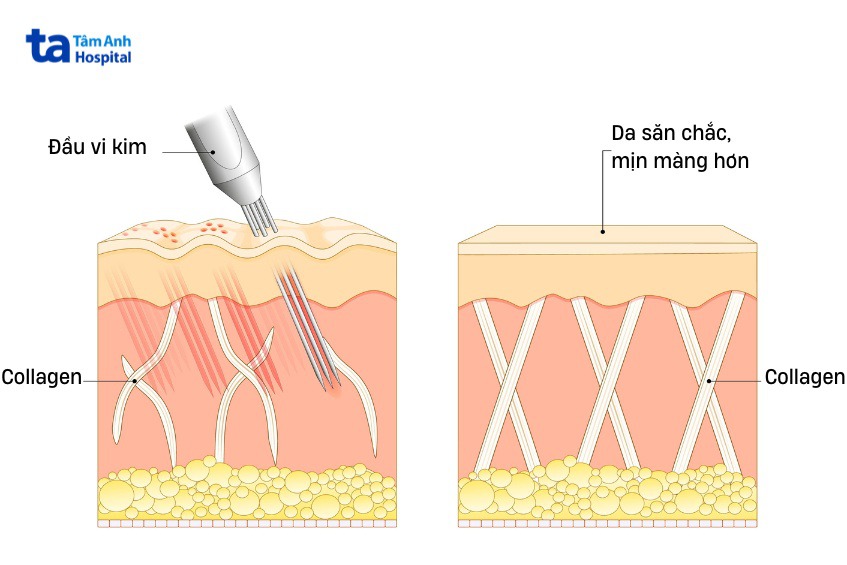 can thiệp công nghệ cao