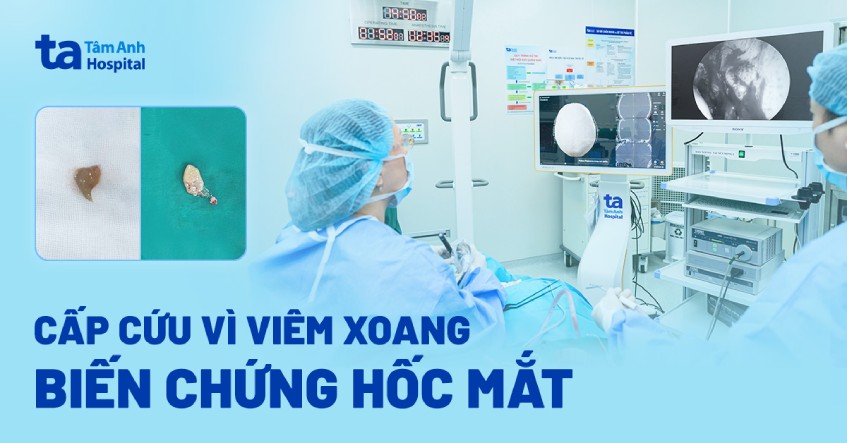 cấp cứu vì viêm xoang biến chứng hốc mắt