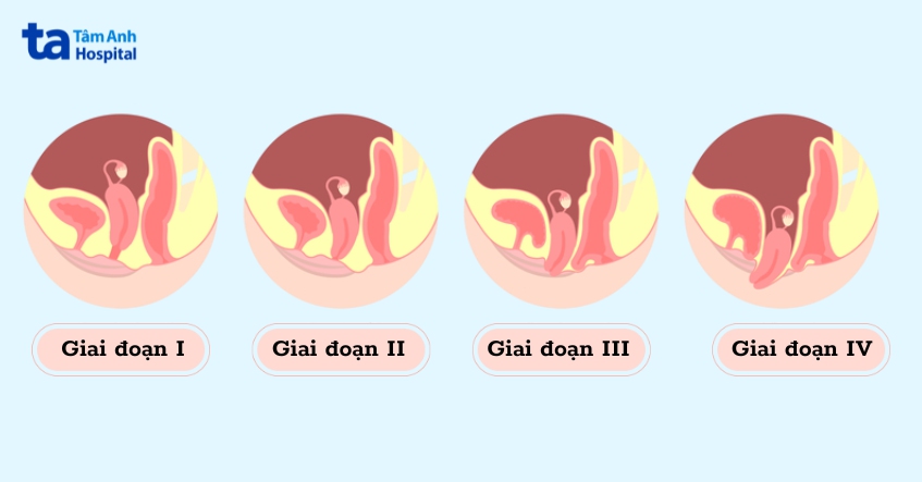 cấp độ nào cũng có thể điều trị