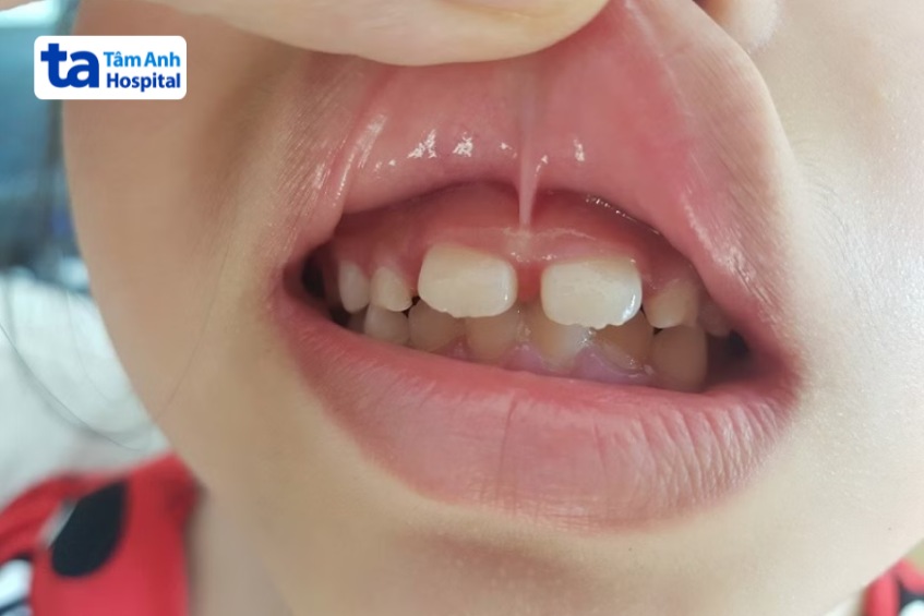 cắt dính thắng môi được chỉ định từ độ 2 trở lên