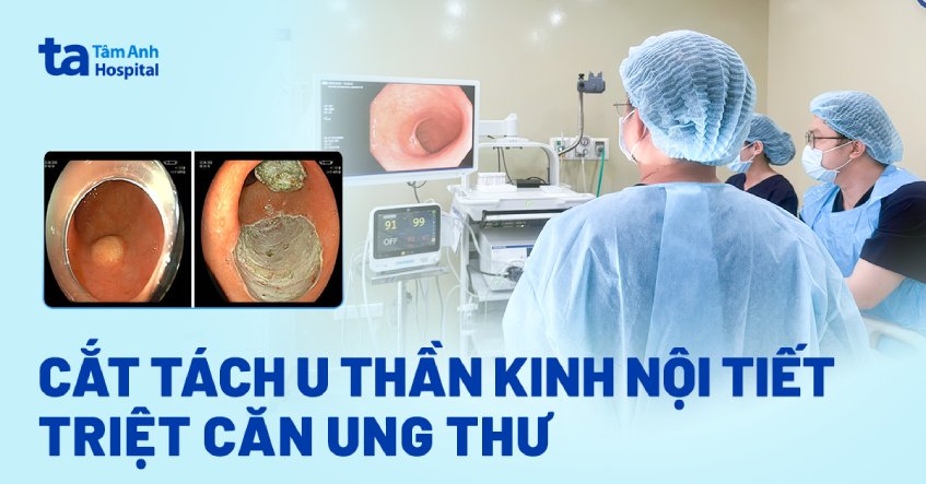 cắt tách u thần kinh nội tiết triệt căn ung thư