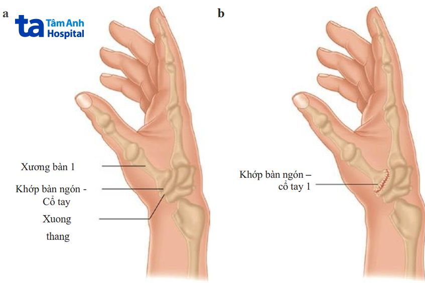 Cấu tạo ngón tay cái