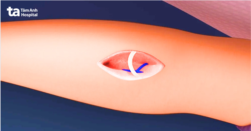 cầu tay chạy thận là mối nối động tĩnh mạch tự thân