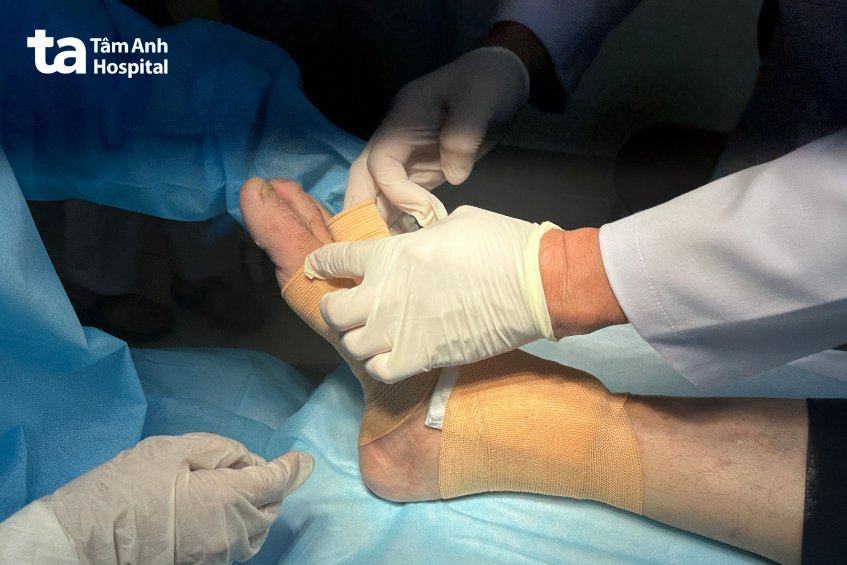 Chăm sóc vết loét bàn chân cho người bệnh tiểu đường