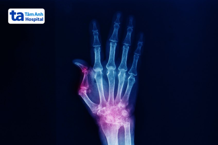 Chẩn đoán chấn thương ngón tay