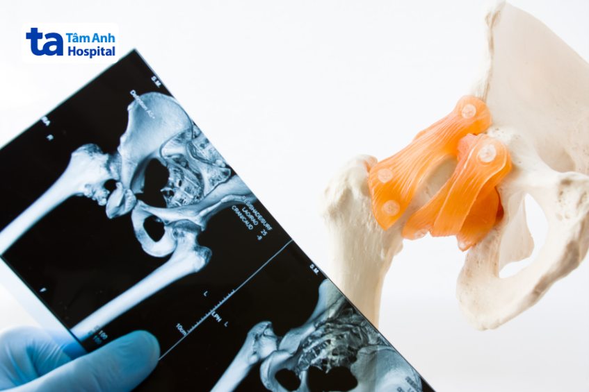 Chẩn đoán hình ảnh viêm khớp háng
