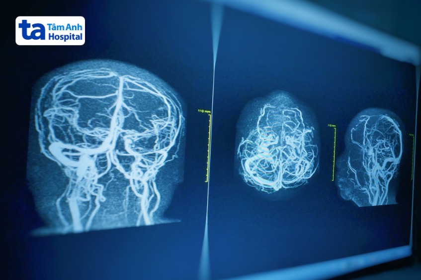 chẩn đoán u tiểu não