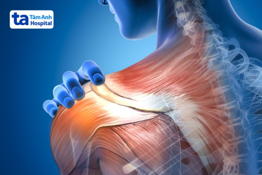 Chấn thương cơ là gì?