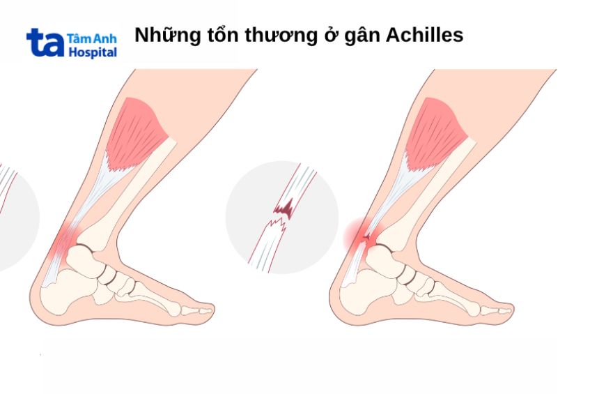 Chấn thương gót chân Achilles là gì?