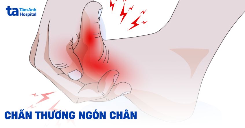 Chấn thương ngón chân: Nguyên nhân, dấu hiệu và cách điều trị