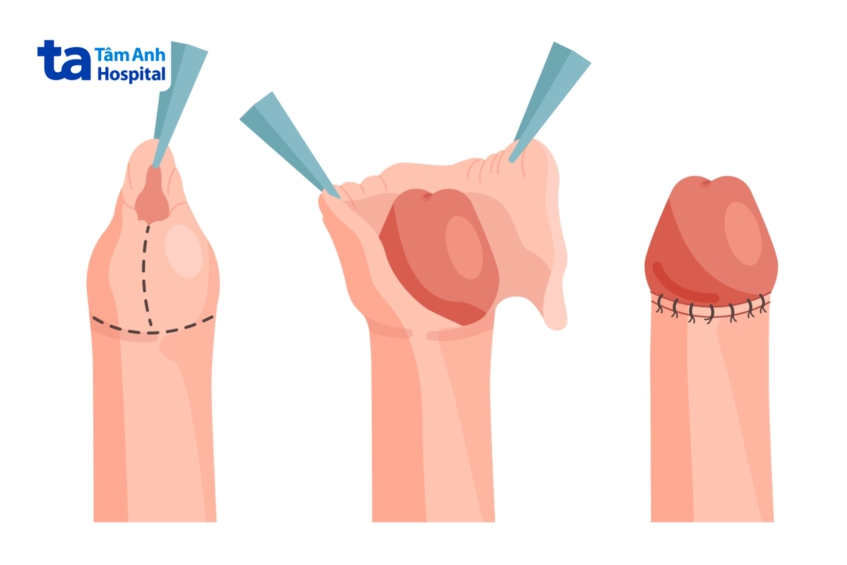 Chỉ thủ thuật cắt bao quy đầu thường tự tiêu sau 7-10 ngày