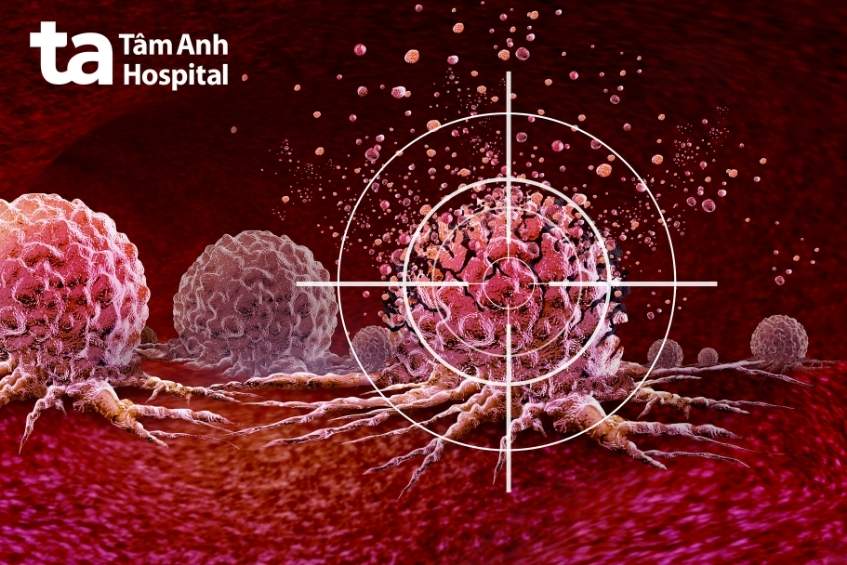 Chọn nơi tầm soát ung thư vú