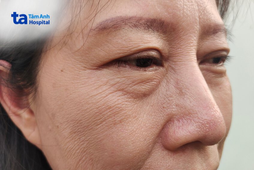 chống chỉ định tiêm meso phục hồi da