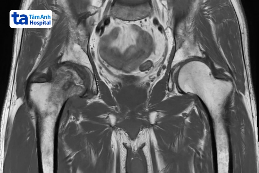 Chương pháp chẩn đoán hình ảnh viêm khớp háng