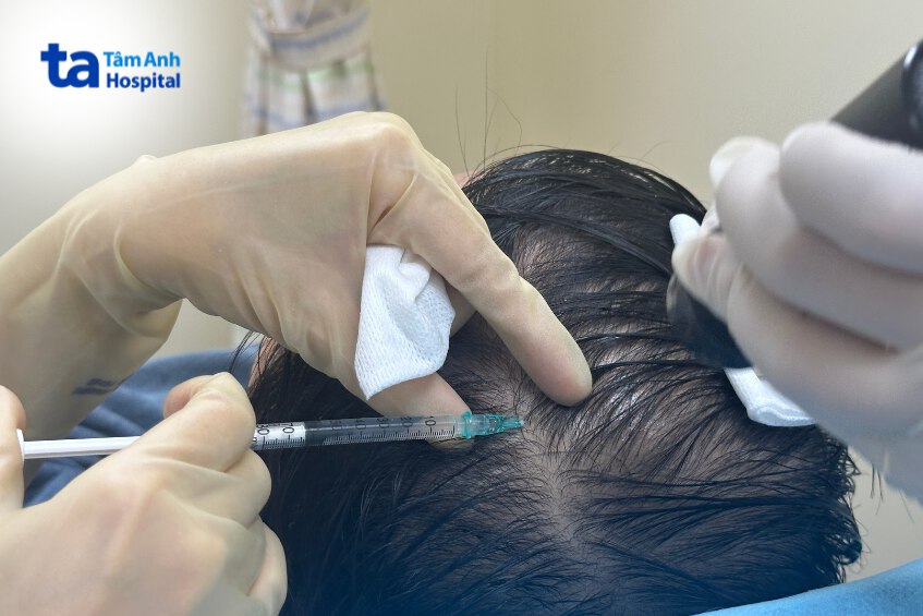 cơ chế hoạt động của tiêm meso kích thích mọc tóc