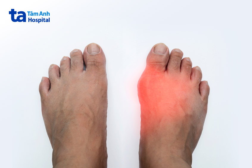 colchicine dùng điều trị gout