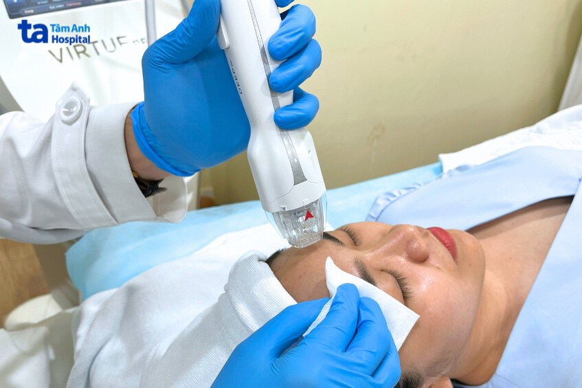 công nghệ vi kim rf hiện đại tại tâm anh