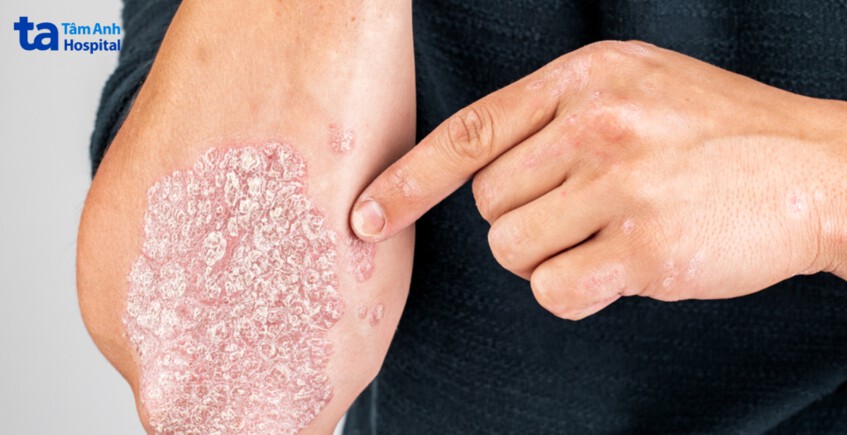 đặc điểm chung giữa bệnh vảy nến và viêm da cơ địa