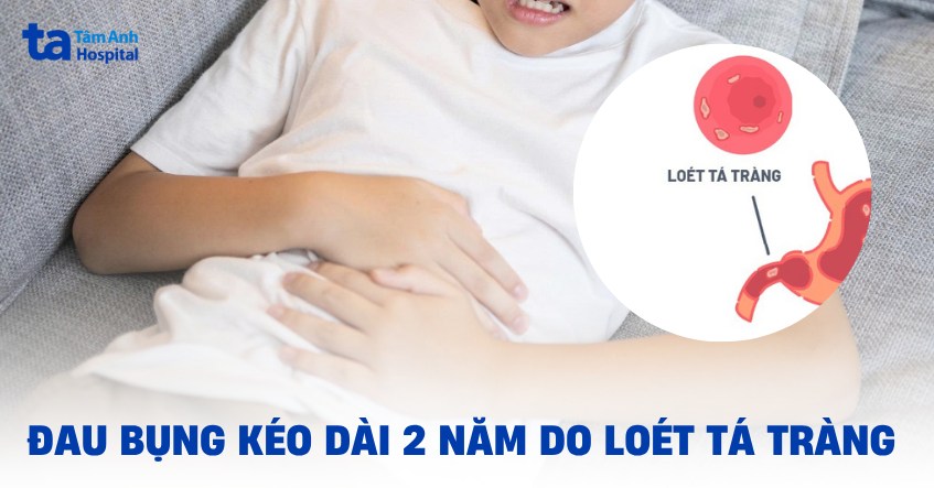đau bụng kéo dài 2 năm do loét tá tràng