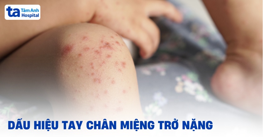 7 dấu hiệu tay chân miệng trở nặng ở trẻ cần phát hiện sớm