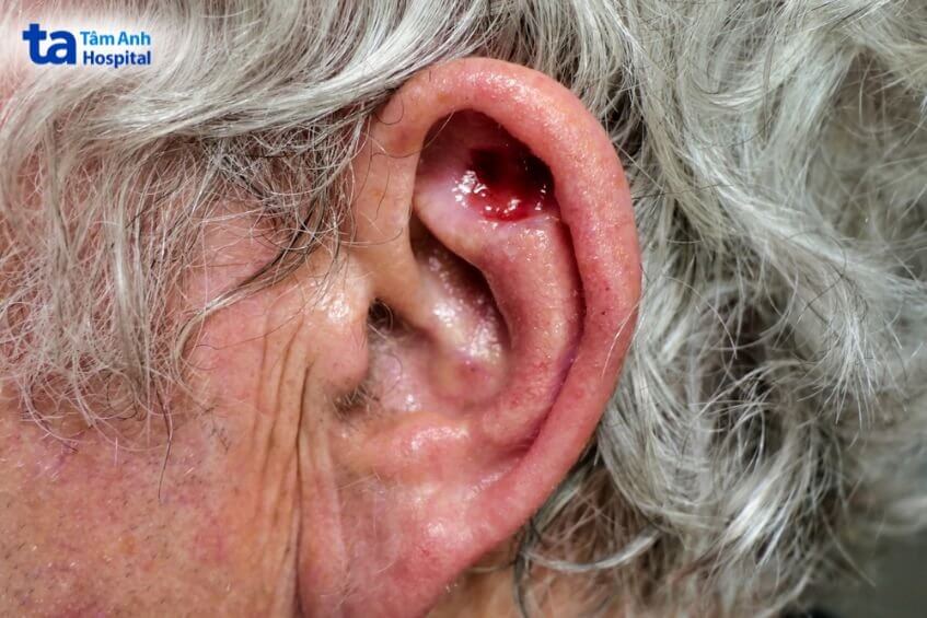 dấu hiệu ung thư tai
