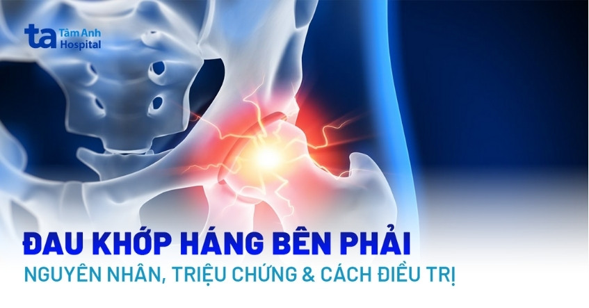 Đau khớp háng bên phải: Nguyên nhân, dấu hiệu và cách điều trị