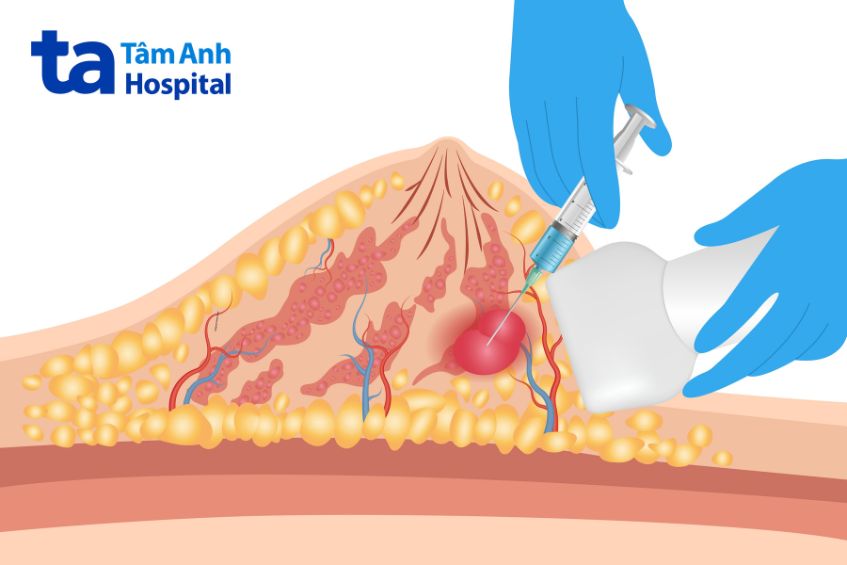 Địa chỉ tầm soát ung thư vú