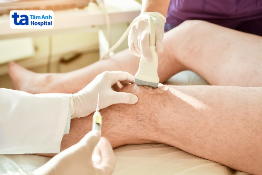 Dịch khớp gối bao nhiêu thì phải hút?