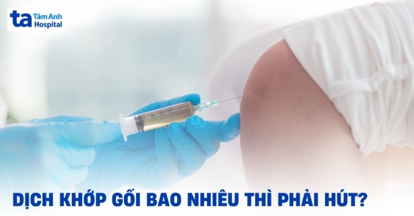 Dịch khớp gối bao nhiêu thì phải hút