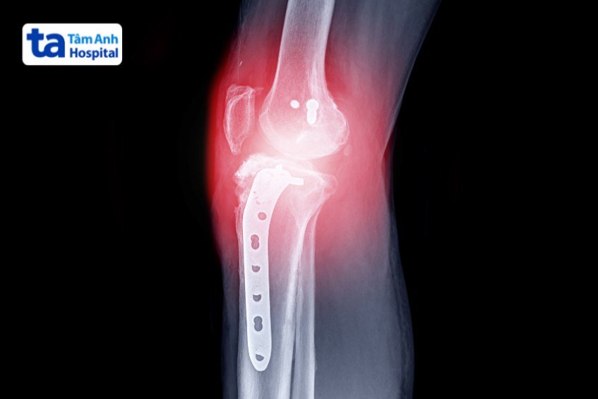 Điều trị vỡ mâm chày