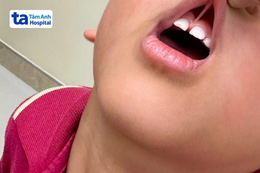 dính thắng môi nặng tạo khe giữa hai răng cửa to