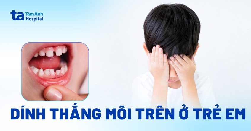 Dính thắng môi trên ở trẻ em: Dấu hiệu nhận biết và cách chữa trị