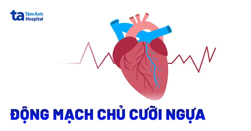 Động mạch chủ cưỡi ngựa là gì? Nguyên nhân, chẩn đoán và điều trị