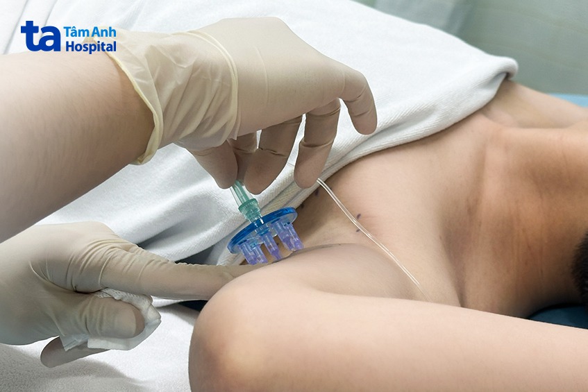 được tiêm tê giảm đau trước khi điều trị