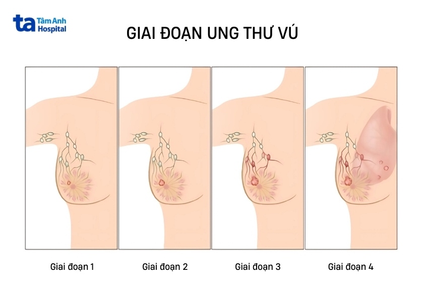 giai đoạn cuối và các giai đoạn ung thư vú