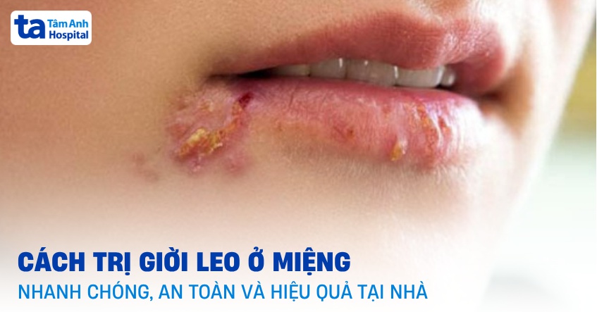 7 cách trị giời leo ở miệng (môi) nhanh nhất tại nhà