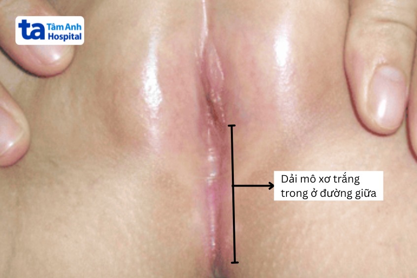 hai môi bé dính vào nhau tạo một dải mô xơ trắng ở đường giữa