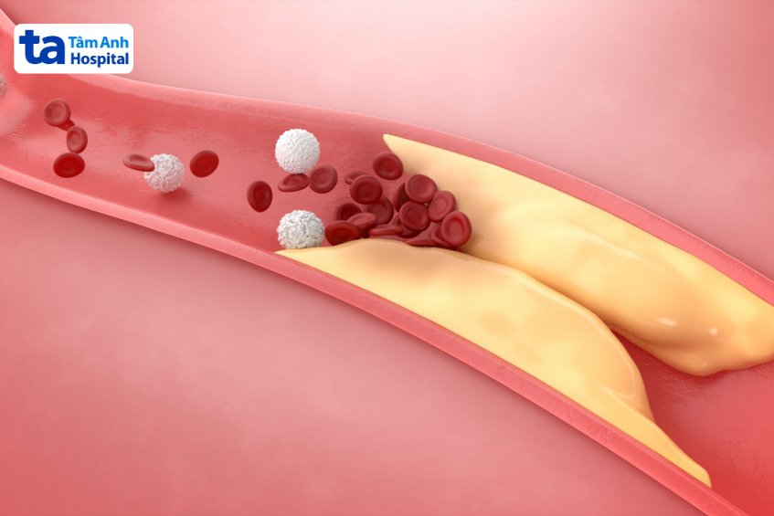 Hẹp mạch vành 90% chưa phải mức nặng nhất, bệnh có thể tiến triển dẫn đến hẹp hoàn toàn 100%
