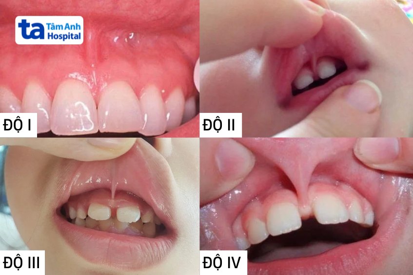 Hình ảnh phanh môi bám thấp theo cấp độ