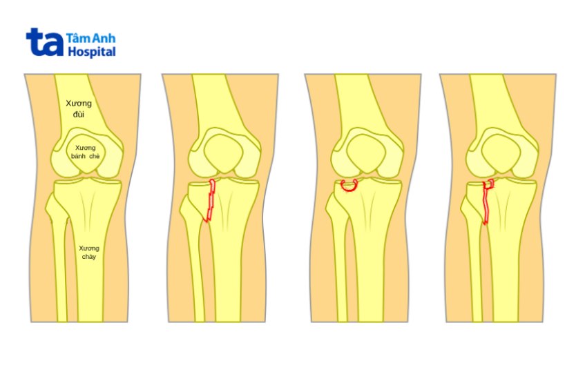 Hình ảnh mâm chày khỏe mạnh