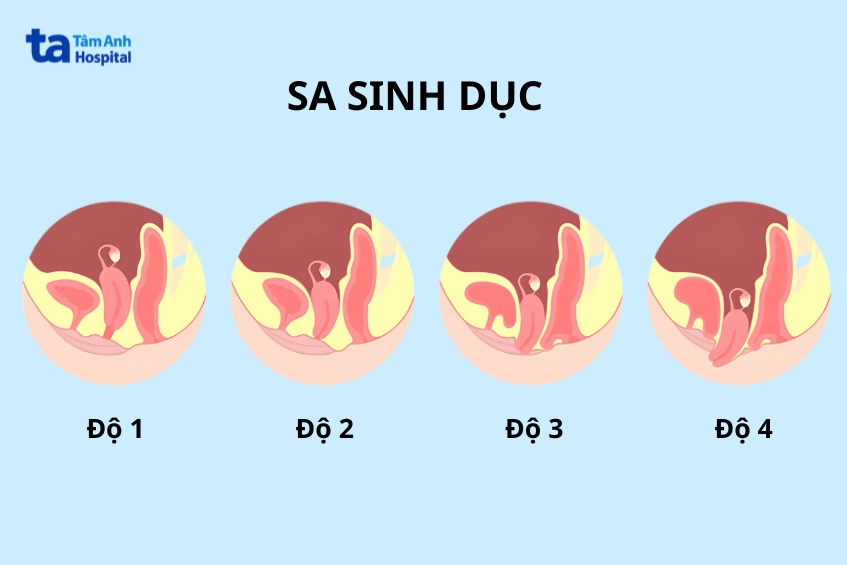 hình ảnh phân cấp sa sinh dục