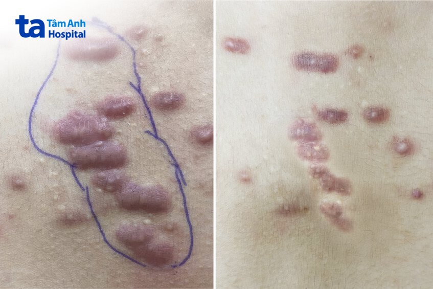 hinh anh seo loi sau bien chung mun