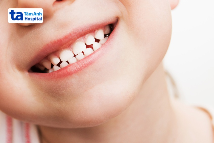 Hình ảnh thắng môi bình thường