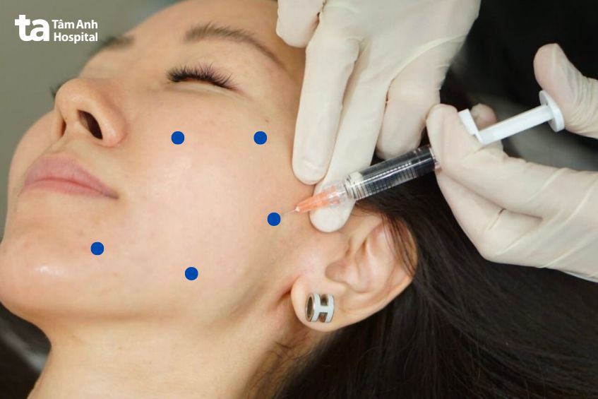 hình ảnh tiêm bap