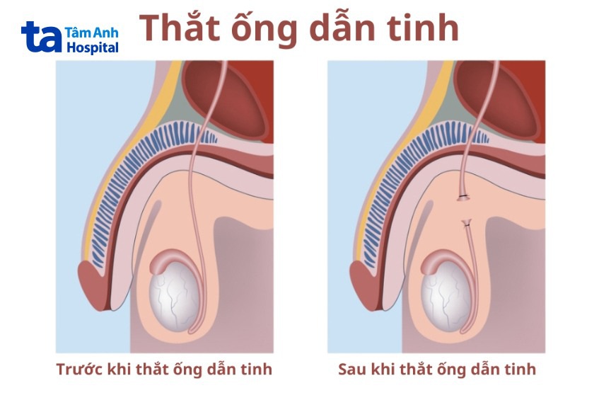 Hình ảnh trước và sau khi thắt ống dẫn tinh