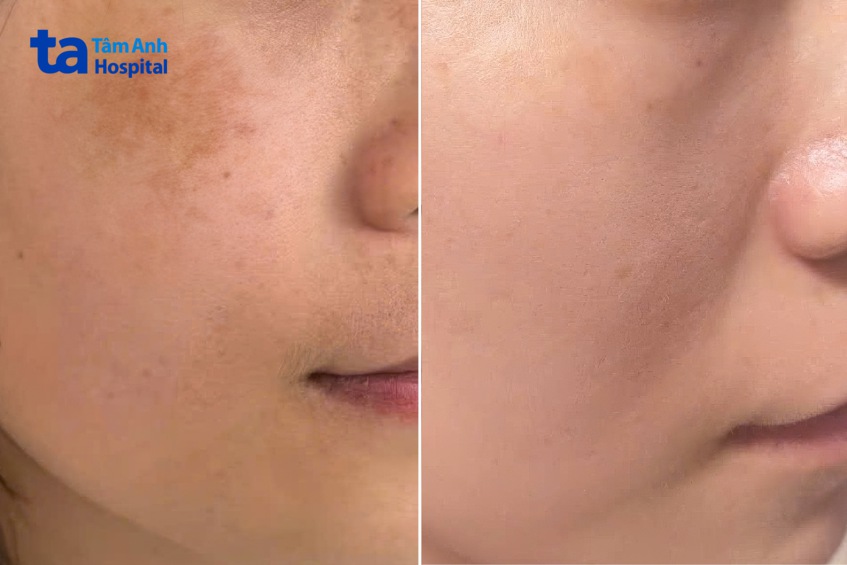 hình ảnh trước và sau